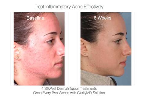 Transform Your Skin With Dermalinfusion In Chicago