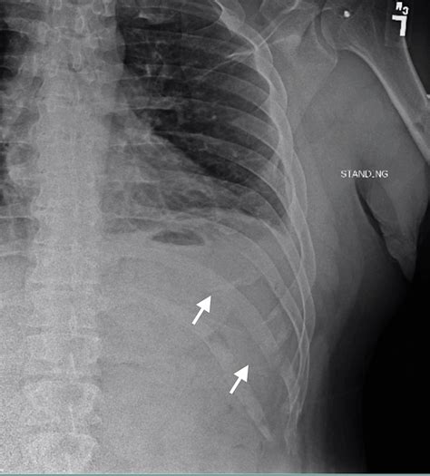 Cureus Outpatient Surgery For Rib Fracture Fixation A Report Of Three Cases