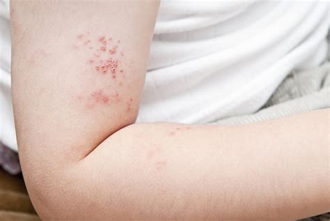Understanding Shingles And Treating This Debilitating Pain Sports And