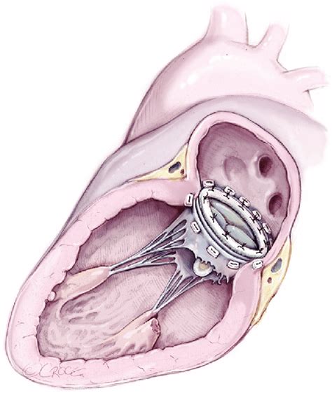 Mitral Valve Replacement By Biological Prosthesis Implantation