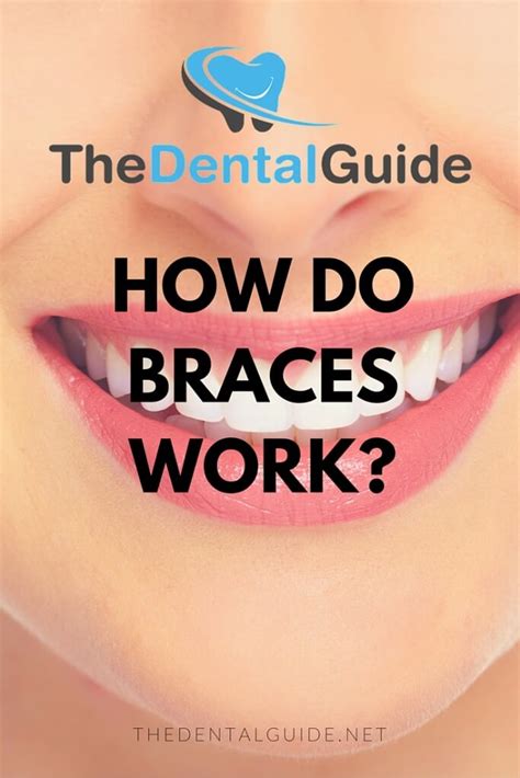 How Do Braces Work The Dental Guide