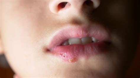 6 Remedies To Combat Cold Sores In Children Step To Health