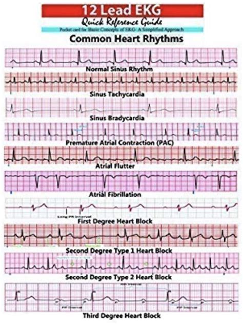 Ekg Examples Of Interpretation Cardiac Nursing Icu Nursing Ekg