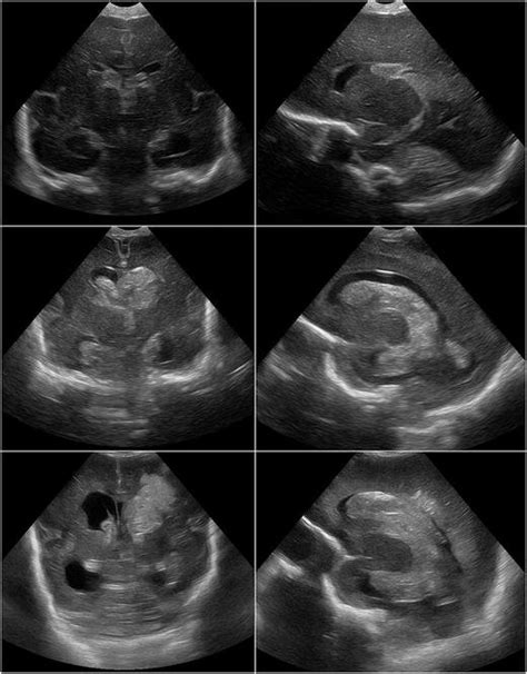Coronal Left And Sagittal Right Head Ultrasound Screen Captures