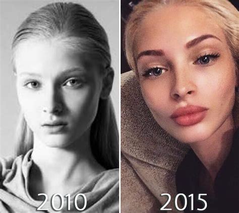 Alena Shishkova Brow Before And After Facial Fillers Lip Injections Lip Fillers