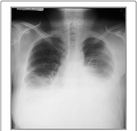 Loss of the costophrenic angle. Chest X-ray showing bilateral pleural effusion. | Download ...