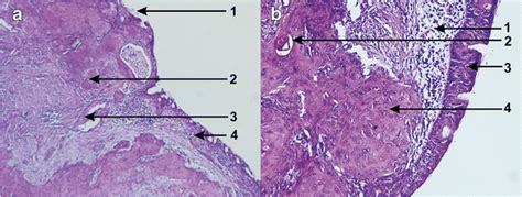 Squamous Cell Carcinoma Of The Larynx Microscopical Aspects At