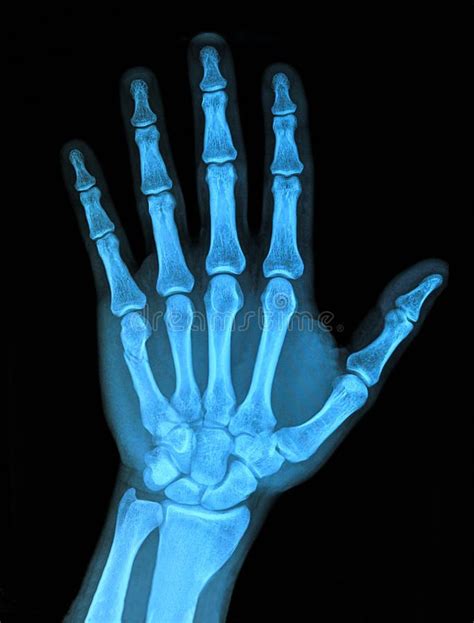Xray Hand X Ray Image Of Right Hand Ad Hand Xray Image Ray
