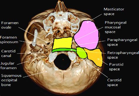 Exocranial Aspect Of Skull Base Showing Attachment Of Deep Neck Spaces