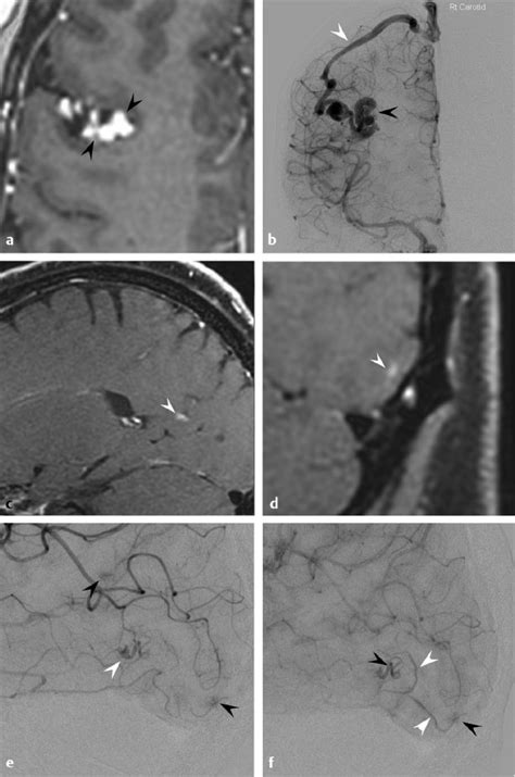 Syndromic Arteriovenous Malformations Neupsy Key