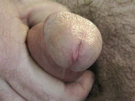 Circumcised Penis Cock Head Closeup 47 Pics Xhamster