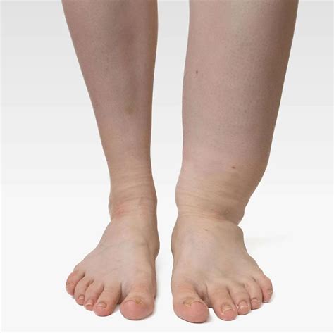 Causes Symptoms Treatments And Prevention Of Edema Swelling