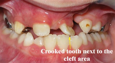 Orthodontic Cleft Lip And Palate Treatment Houston