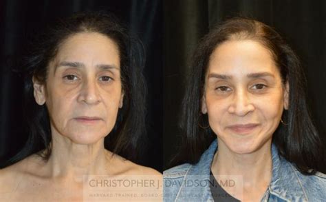 Facelift Surgery Before And After Photo Gallery Boston Ma Christopher J Davidson Md