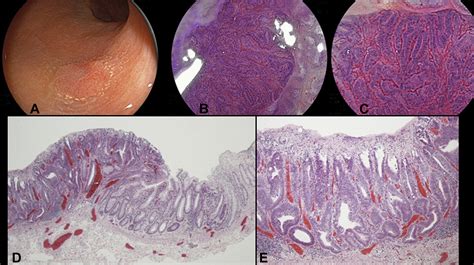 Magnified Endoscopic Observation Of Early Colorectal Cancer By Linked