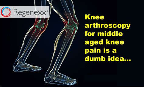 Knee Surgery For A Meniscus Tear Not If Youre Middle Aged