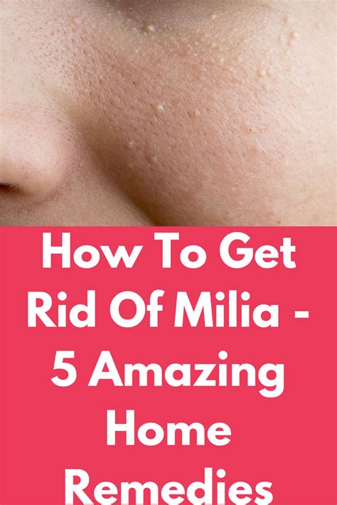 How To Get Rid Of Milia 5 Amazing Home Remedies Skin Bumps White