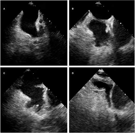 Frontiers The Association Of Left Atrial Appendage Morphology To