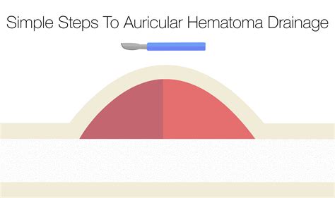 Simple Steps To Auricular Hematoma Drainage — Nuem Blog