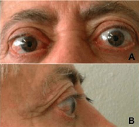 A Clinical Photograph Of A Patient With Thyroid Eye Disease Showing