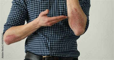 Man With Sick Hands Dry Flaky Skin On His Hand With Vulgar Psoriasis