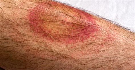Lyme Disease Symptoms Bulls Eye Rash Isnt Whole Story Cbs News