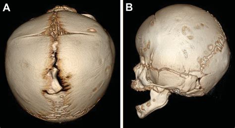 Pediatric Craniosynostosis Uf Pediatric Neurosurgery Pediatric