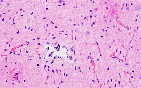 Pathology Outlines Gangliocytoma And Ganglioglioma