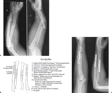 Forearm Fractures Radiology Key