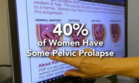 Pelvic Organ Prolapse Symptoms Treatment And Surgical Options The Hiu