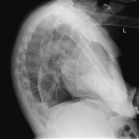 Iatrogenic Pneumothorax Image Radiopaedia Org