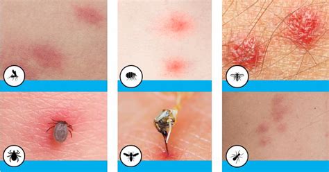 10 Common Bug Bites You Should Know How To Identify