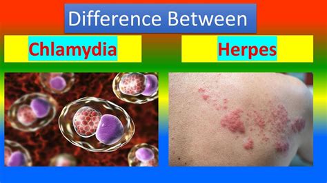 Difference Between Chlamydia And Herpes Youtube