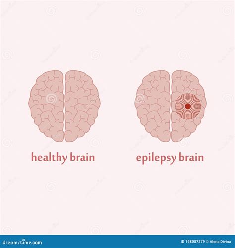 Epilepsie Gehirn Vektor Abbildung Illustration Von Gesundheit 158087279