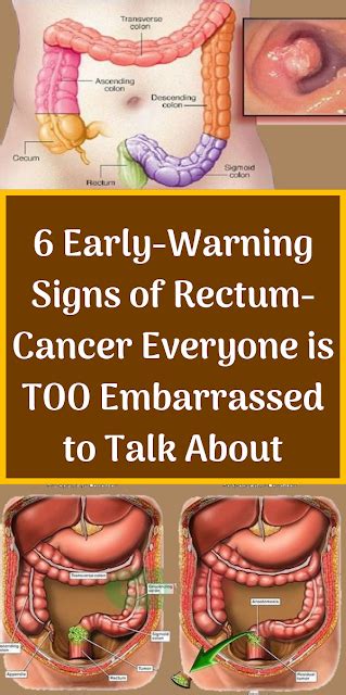 6 Early Warning Signs Of Rectum Cancer Everyone Is Too Embarrassed To Talk About