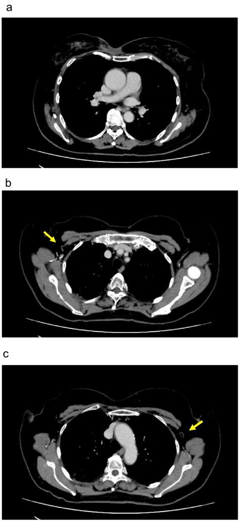Contrast Enhanced Ct Imaging After Preoperative Chemotherapy A The