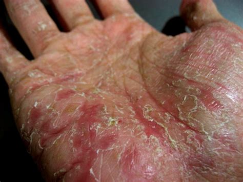 Watery Blisters On Hands Pictures Photos