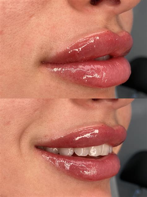 What You Need To Know About Russian Lip Fillers