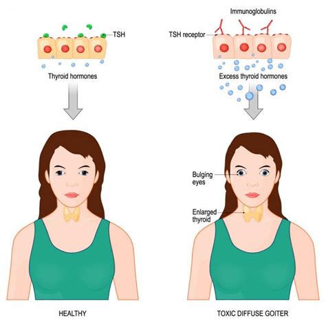 Hypothyroidism Symptoms Before And After