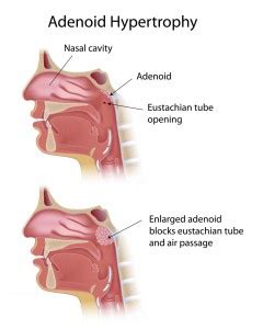 Tonsillectomy And Adenoidectomy T A Fort Worth Ent Sinus