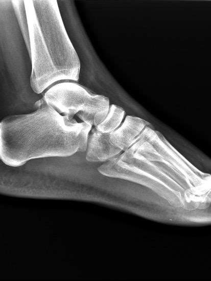 Cuboid Fracture The Foot And Ankle Online Journal