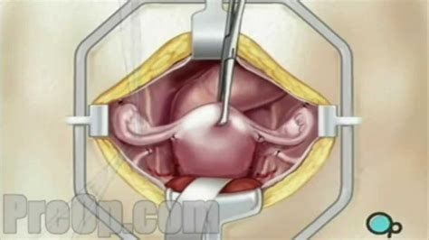 Preop Hysterectomy Removal Of Uterus Ovaries And Fallopian Tubes