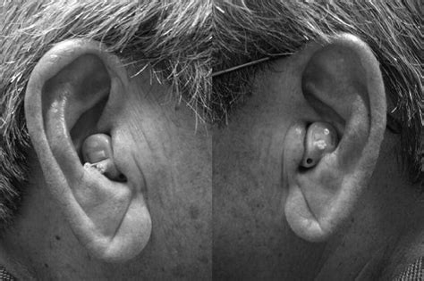 Association Between Clinically Identified Diagonal Earlobe Creases And