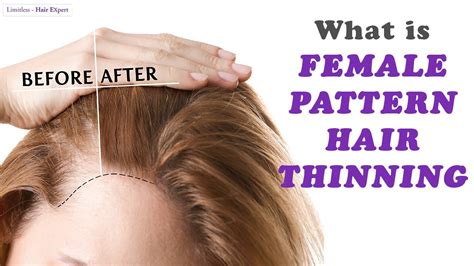 I have learned a thing or two when it comes to various ways to manage very thin, stringy, and even sparse thinning tresses! Everything Women should KNOW about Female Pattern Hair ...