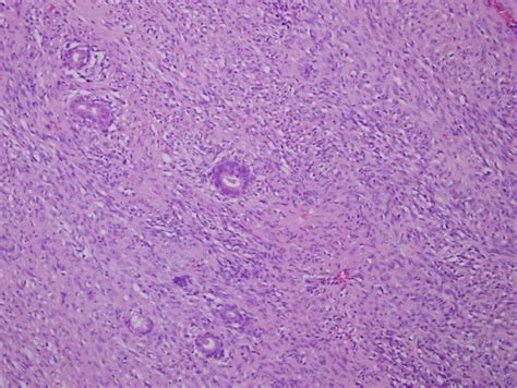 Pathology Outlines Deep Fibrous Histiocytoma