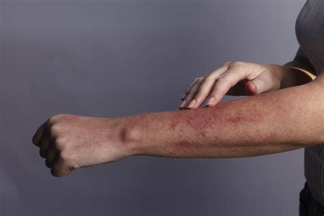 Causes Of Itchy Skin Pruritis