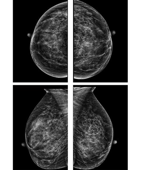 Clinically Indeterminate Breast Lesions With Normal Imaging A