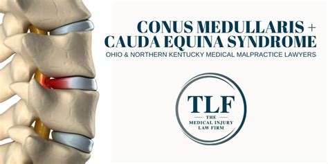 Conus Medullaris And Cauda Equina Syndrome Malpractice Lawyers