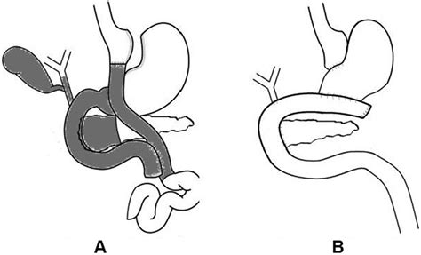 Transgastric Endoscopy And Pancreaticoduodenectomy After Roux En Y