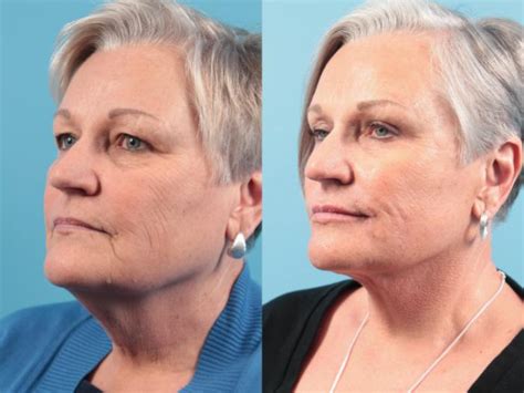 Facelift Before And After Pictures Case 111 West Des Moines Ia